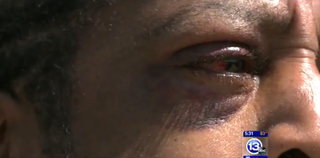 Adrian Williams shows close-up image of eye injury suffered during what authorities say was a bias attack.